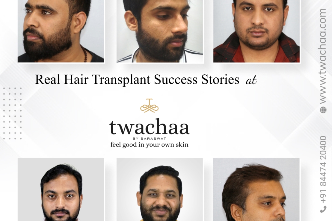 Before and After: Hair Transplant Success Stories at Twachaa by Saraswat
